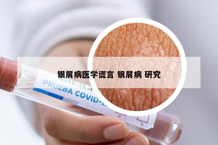 银屑病医学谎言 银屑病 研究