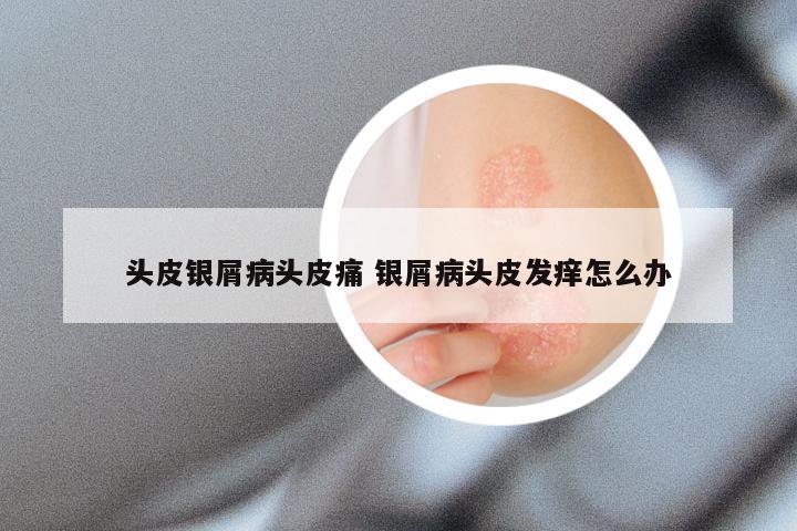 头皮银屑病头皮痛 银屑病头皮发痒怎么办