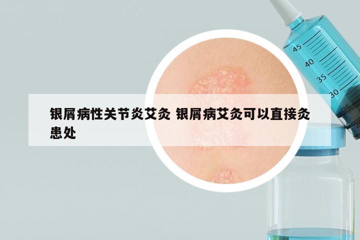 银屑病性关节炎艾灸 银屑病艾灸可以直接灸患处