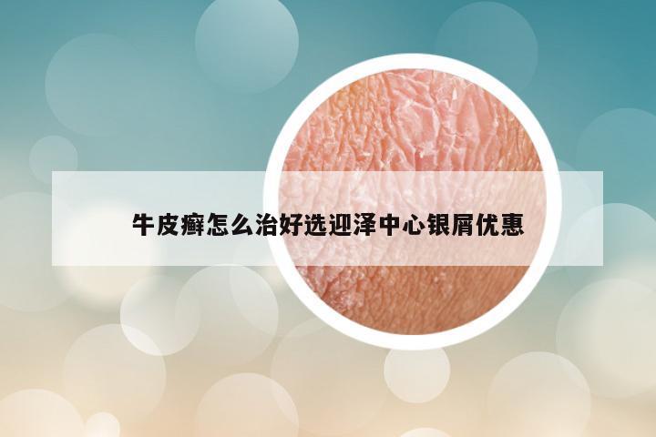 牛皮癣怎么治好选迎泽中心银屑优惠