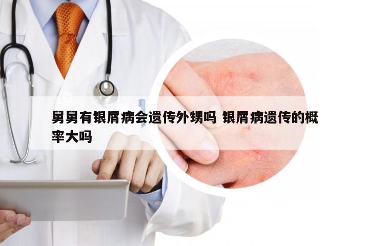 舅舅有银屑病会遗传外甥吗 银屑病遗传的概率大吗
