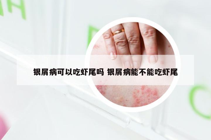 银屑病可以吃虾尾吗 银屑病能不能吃虾尾