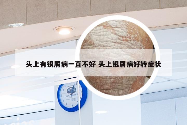 头上有银屑病一直不好 头上银屑病好转症状