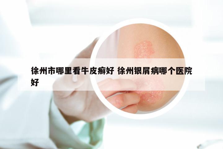 徐州市哪里看牛皮癣好 徐州银屑病哪个医院好