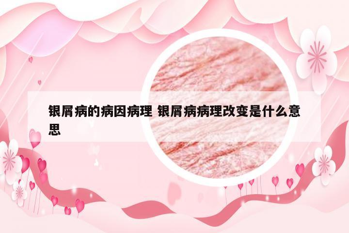 银屑病的病因病理 银屑病病理改变是什么意思
