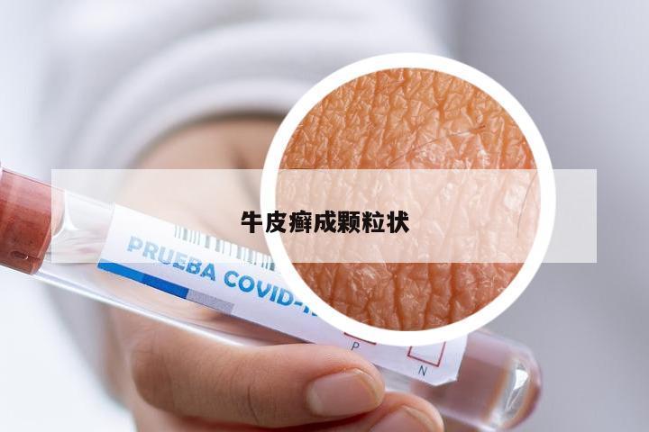牛皮癣成颗粒状