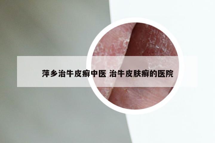 萍乡治牛皮癣中医 治牛皮肤癣的医院