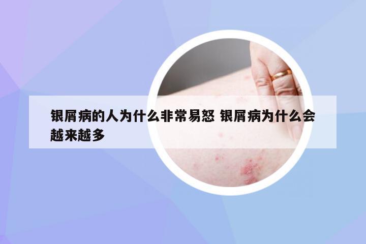 银屑病的人为什么非常易怒 银屑病为什么会越来越多