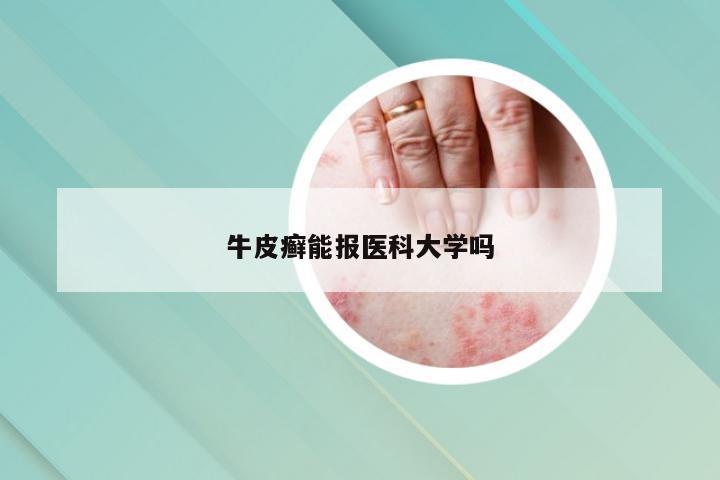 牛皮癣能报医科大学吗