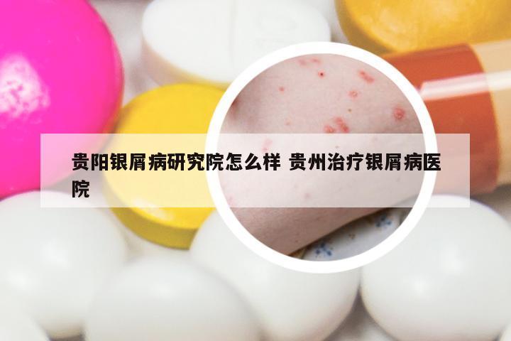 贵阳银屑病研究院怎么样 贵州治疗银屑病医院