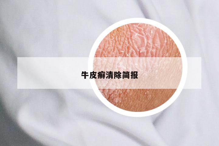 牛皮癣清除简报