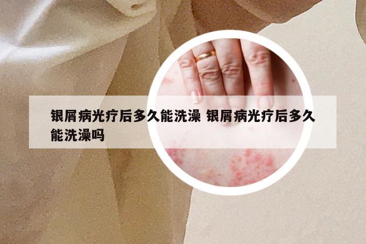 银屑病光疗后多久能洗澡 银屑病光疗后多久能洗澡吗