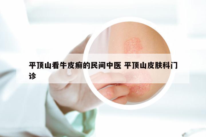 平顶山看牛皮癣的民间中医 平顶山皮肤科门诊