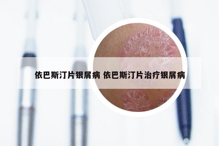 依巴斯汀片银屑病 依巴斯汀片治疗银屑病