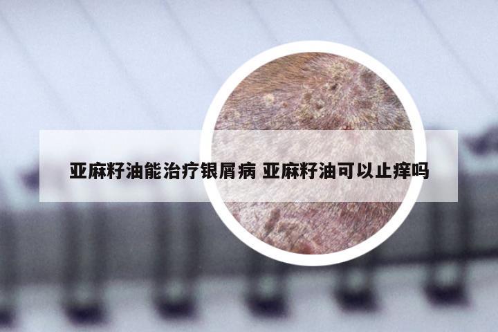 亚麻籽油能治疗银屑病 亚麻籽油可以止痒吗