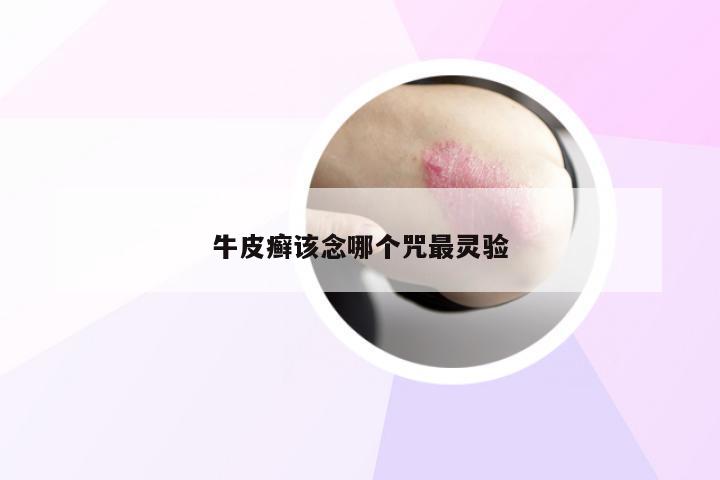牛皮癣该念哪个咒最灵验