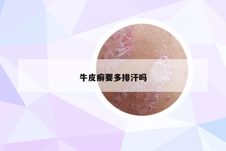 牛皮癣要多排汗吗