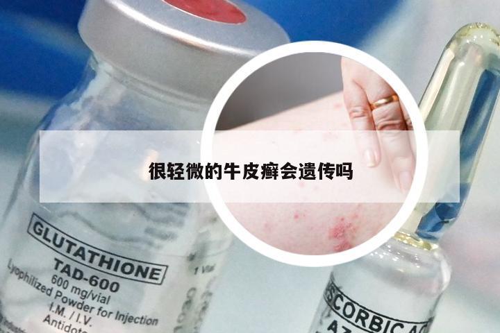 很轻微的牛皮癣会遗传吗