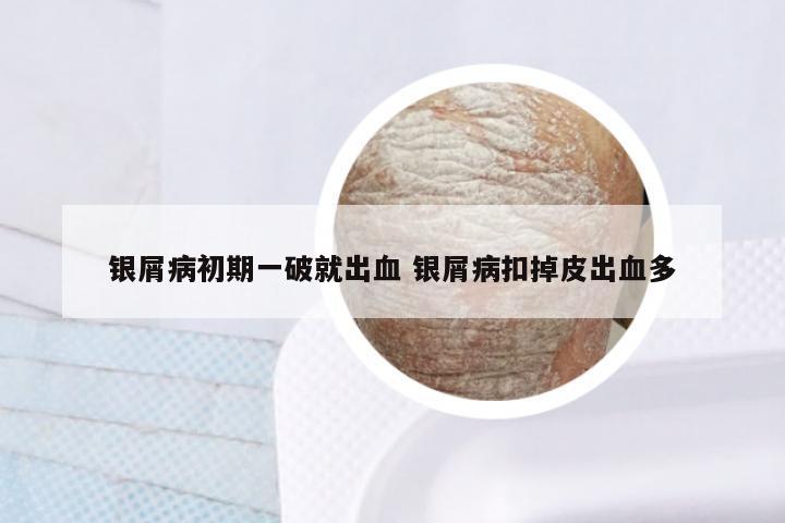 银屑病初期一破就出血 银屑病扣掉皮出血多