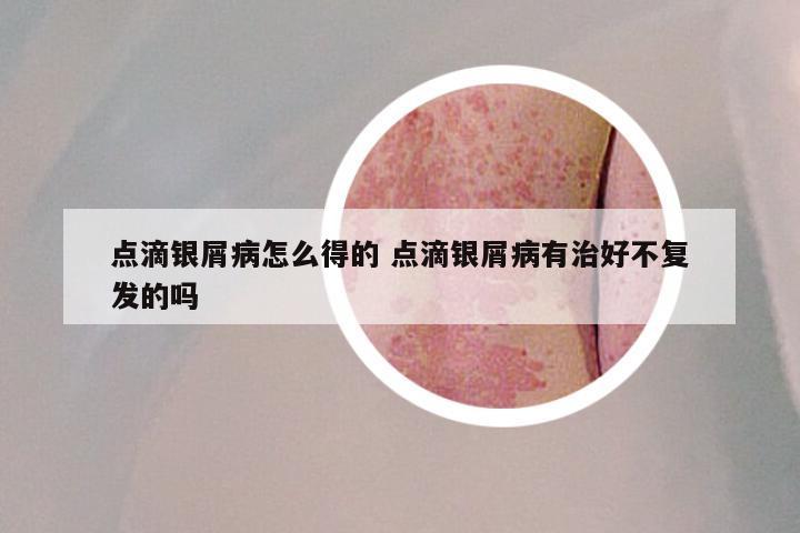 点滴银屑病怎么得的 点滴银屑病有治好不复发的吗
