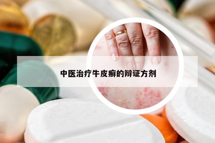 中医治疗牛皮癣的辩证方剂