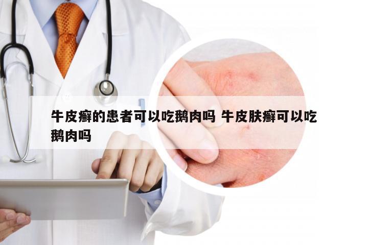 牛皮癣的患者可以吃鹅肉吗 牛皮肤癣可以吃鹅肉吗