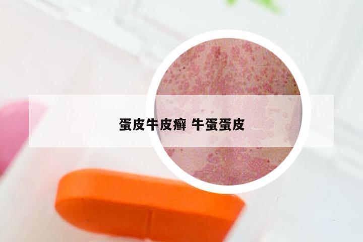 蛋皮牛皮癣 牛蛋蛋皮