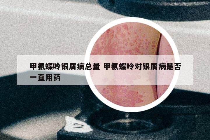 甲氨蝶呤银屑病总量 甲氨蝶呤对银屑病是否一直用药