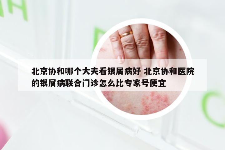 北京协和哪个大夫看银屑病好 北京协和医院的银屑病联合门诊怎么比专家号便宜