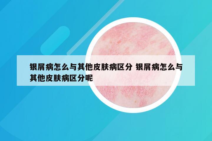 银屑病怎么与其他皮肤病区分 银屑病怎么与其他皮肤病区分呢