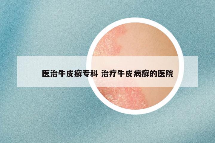 医治牛皮癣专科 治疗牛皮病癣的医院