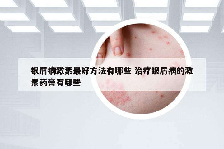 银屑病激素最好方法有哪些 治疗银屑病的激素药膏有哪些