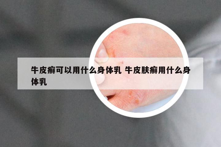 牛皮癣可以用什么身体乳 牛皮肤癣用什么身体乳