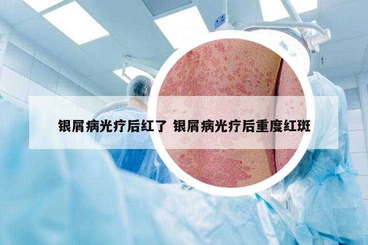 银屑病光疗后红了 银屑病光疗后重度红斑