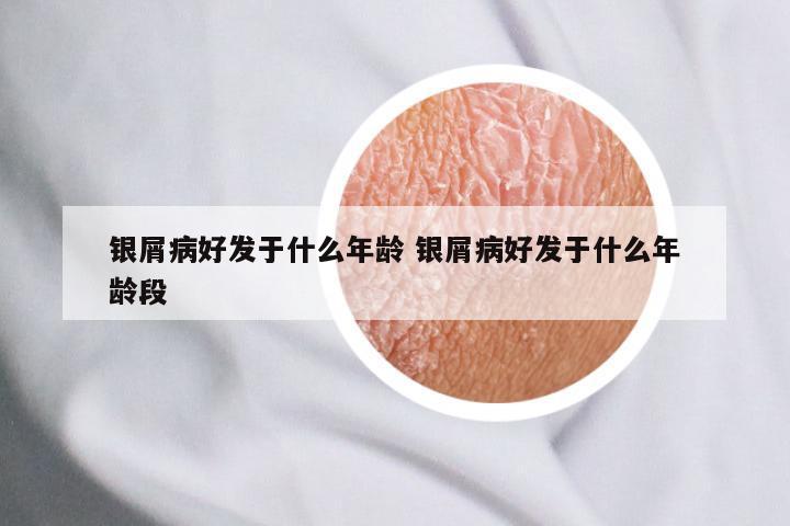 银屑病好发于什么年龄 银屑病好发于什么年龄段