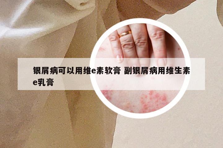 银屑病可以用维e素软膏 副银屑病用维生素e乳膏