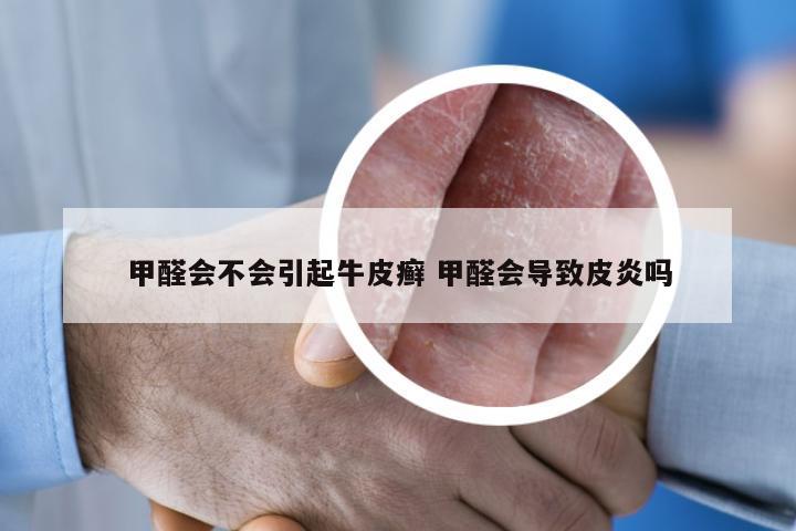 甲醛会不会引起牛皮癣 甲醛会导致皮炎吗