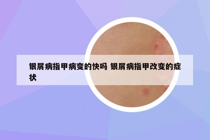 银屑病指甲病变的快吗 银屑病指甲改变的症状