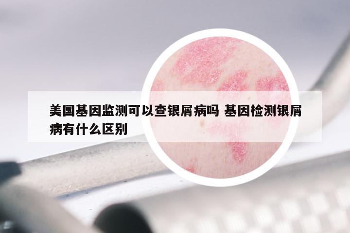 美国基因监测可以查银屑病吗 基因检测银屑病有什么区别