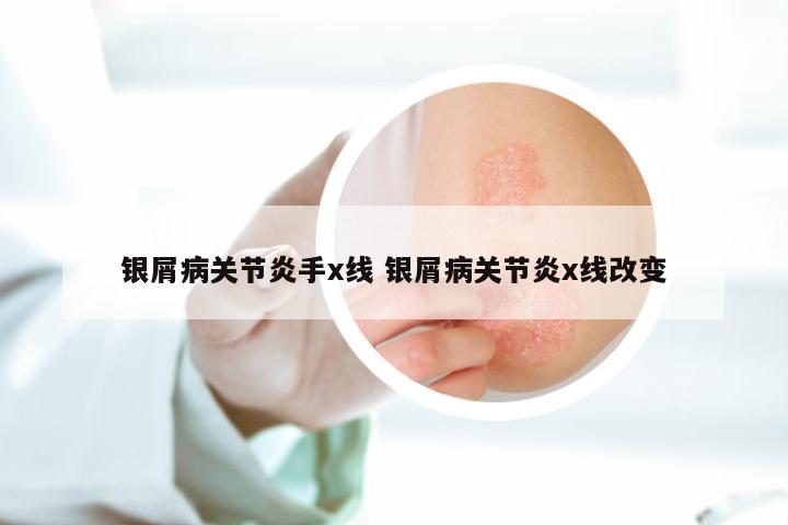 银屑病关节炎手x线 银屑病关节炎x线改变