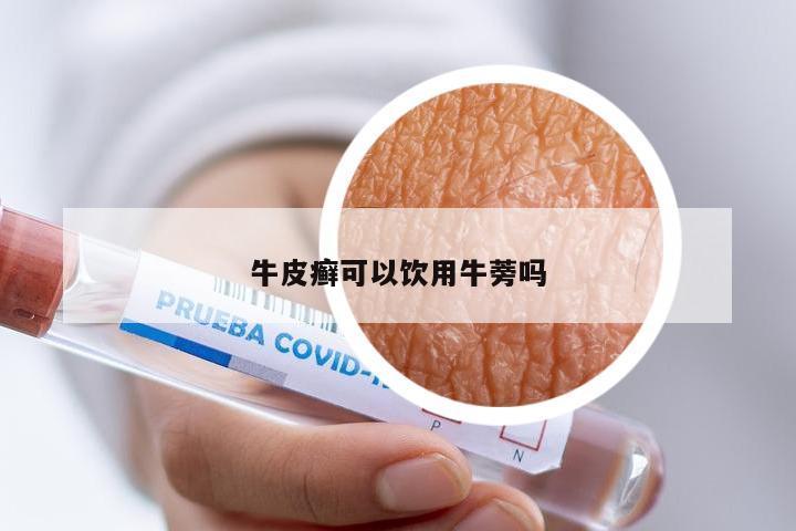牛皮癣可以饮用牛蒡吗