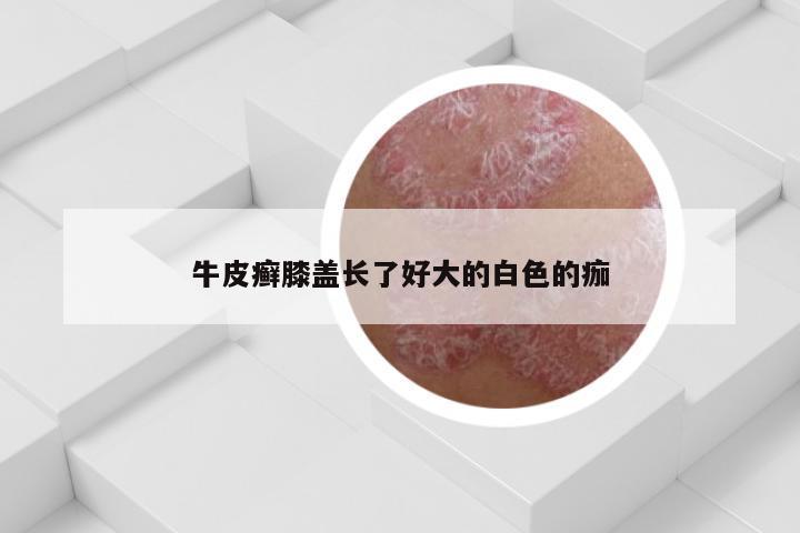 牛皮癣膝盖长了好大的白色的痂