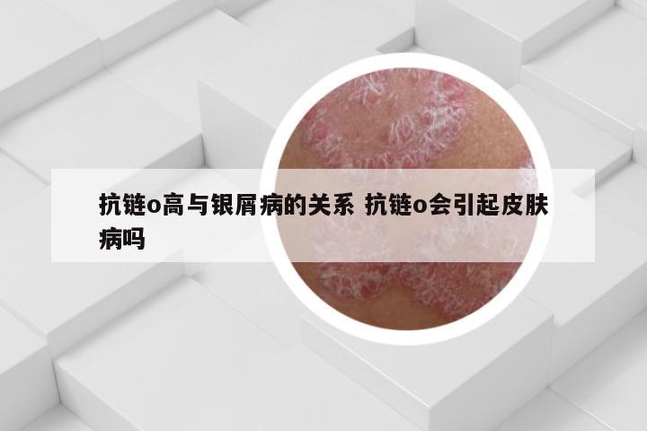 抗链o高与银屑病的关系 抗链o会引起皮肤病吗