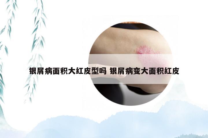 银屑病面积大红皮型吗 银屑病变大面积红皮