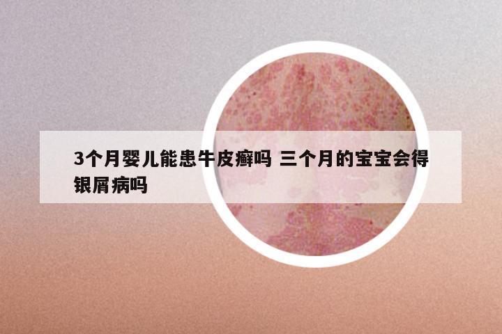 3个月婴儿能患牛皮癣吗 三个月的宝宝会得银屑病吗