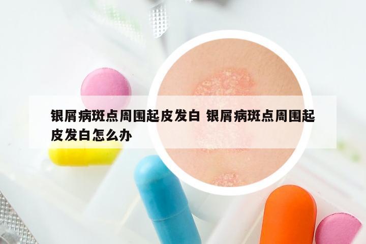 银屑病斑点周围起皮发白 银屑病斑点周围起皮发白怎么办