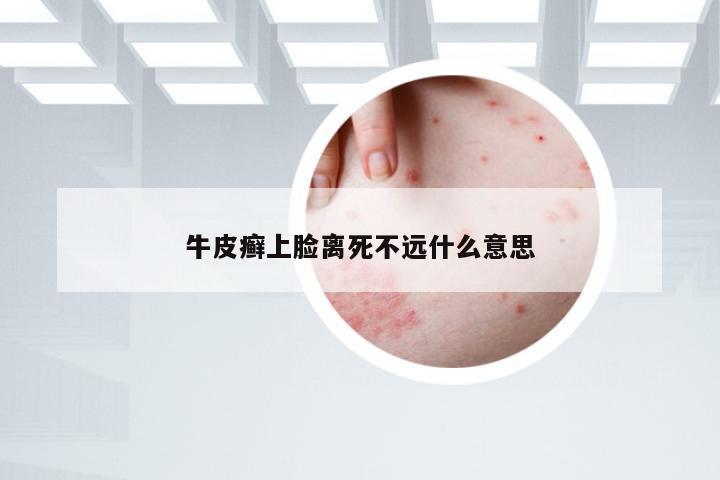 牛皮癣上脸离死不远什么意思