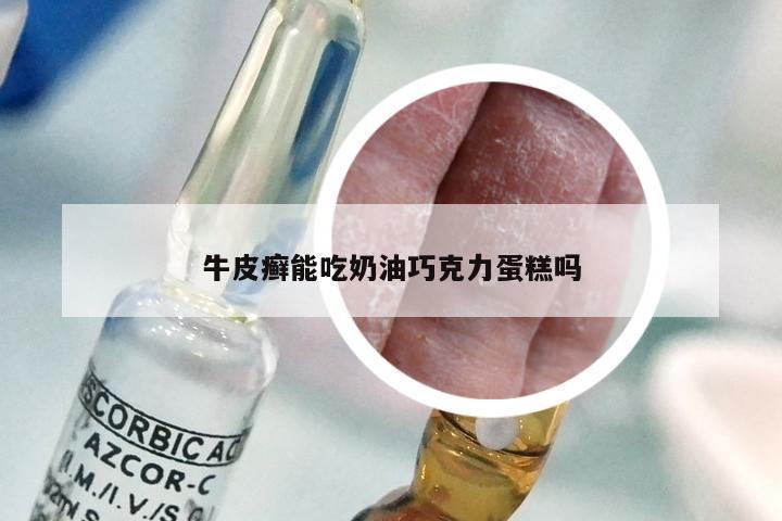 牛皮癣能吃奶油巧克力蛋糕吗