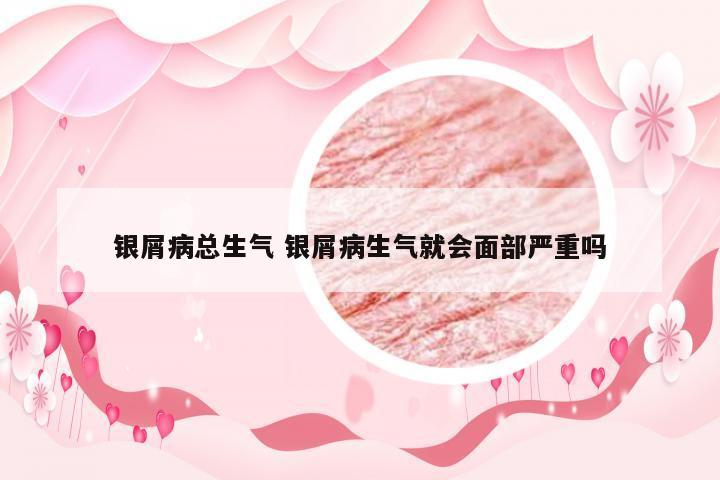 银屑病总生气 银屑病生气就会面部严重吗