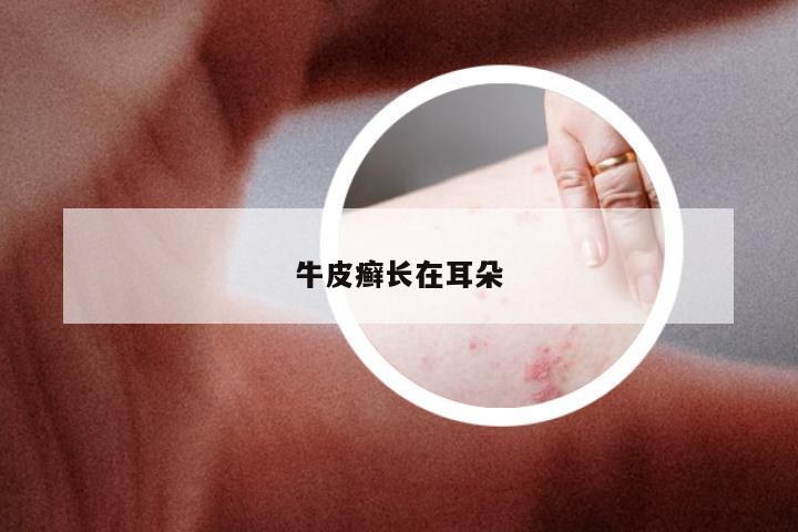 牛皮癣长在耳朵